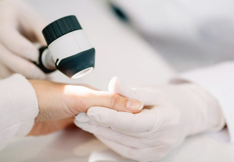 Dermatoložka mi našla nebezpečné znaménko. Co s tím a jak na prevenci?