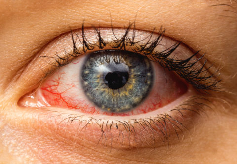 Když oči rudnou a pálí: Co dělat se zánětem spojivek?